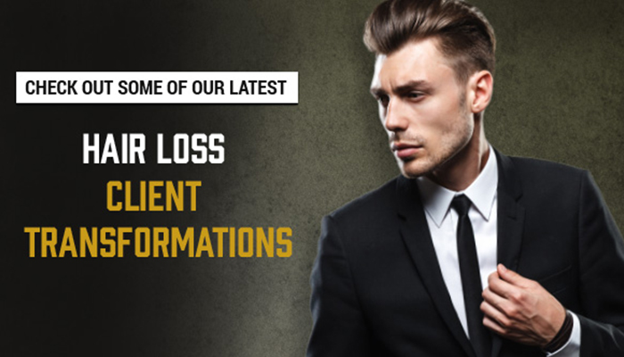 Hair loss client transformations banner 01