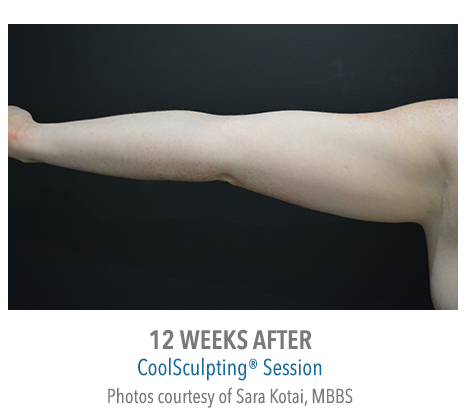Arm CoolSculpting, patient 12 weeks post treatment, The Bay Medispa Sydney