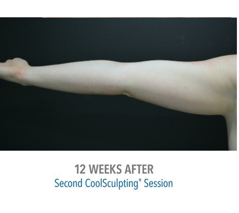 Arm CoolSculpting, patient 12 weeks after 08, The Bay Medispa