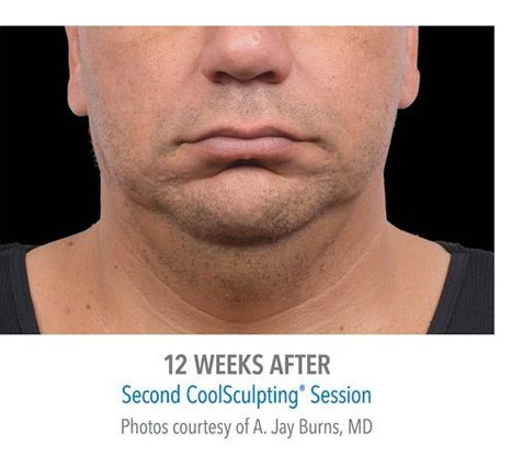 Chin CoolSculpting patient 09, 12 weeks after, The Bay Medispa