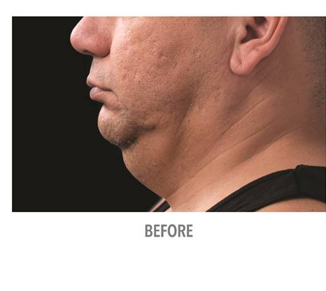 Fat freezing, chin area, male patient before treatment 05