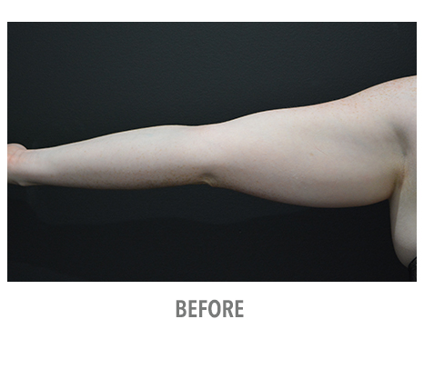 Fat freezing (CoolSculpting), before and afters, patient 06 before arm treatment