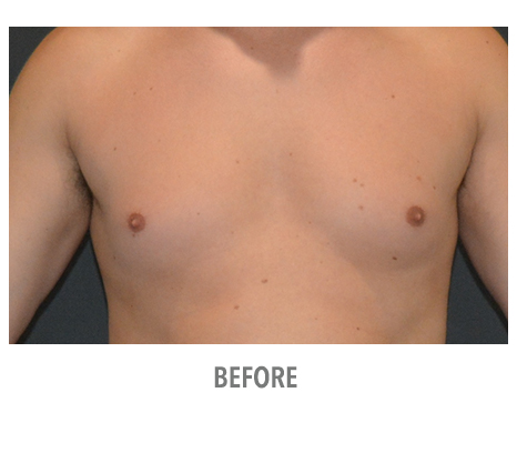 Fat freezing before & after, patient 07 before treatment, The Bay Medispa Sydney